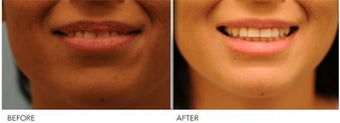 Upper Lip Reduction for Traumatic Lip Deformity 391530