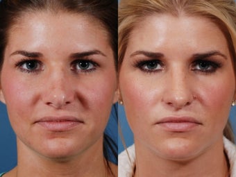 Revision rhinoplasty before 395562