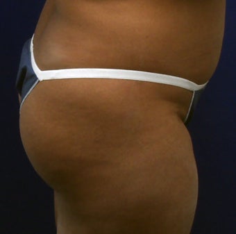 Butt Augmentation before 273286