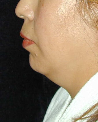 Chin Implant before 101324