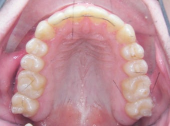 Damon Braces 378589