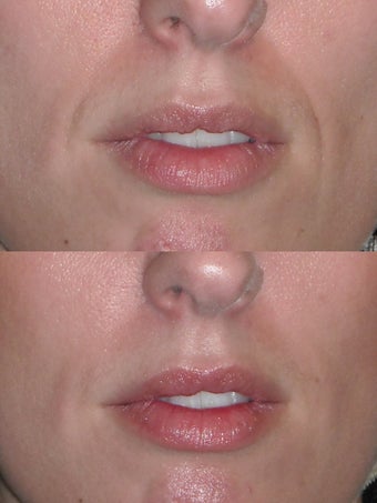 Filler to nasolabial folds before 495119
