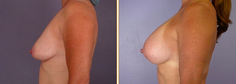 Breast Implants before 271066