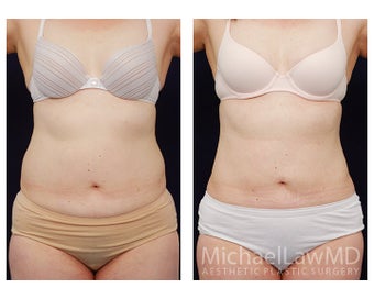 Liposuction before 495473