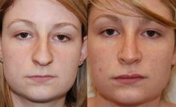 Rhinoplasty and Lip Enhancement with Silikon-1000 before 112461
