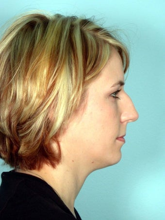 Rhinoplasty before 185996