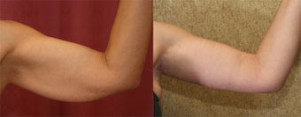 brachioplasty before 242125
