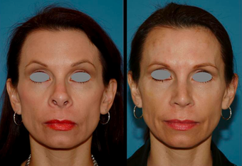 Revision Rhinoplasty (open) before 306788