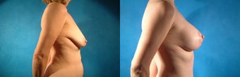 Breast Lift and Augmentation before 134099