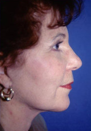 Facelift and Eyelid Surgery 316338