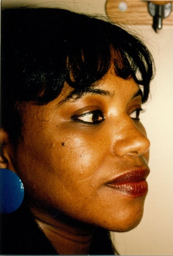 Rhinoplasty after 383009