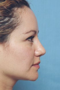Revision Rhinoplasty after 581092