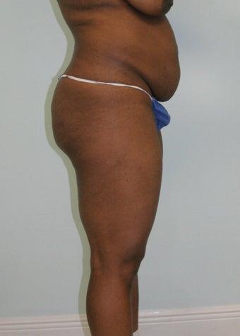 Brazilian butt lift 365596