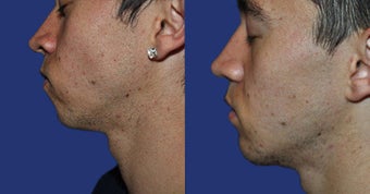 Chin Augmentation before 633487