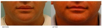 Lip Reduction/Lip Correction before 136724
