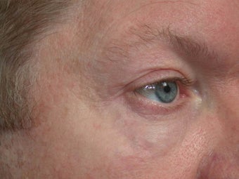 Sclerotherapy (eyelid) after 332441