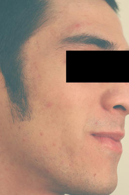 Laser Acne Treatment after 82963