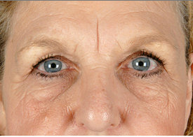 Browlift and Upper/Lower Eyelid Surgery before 253601