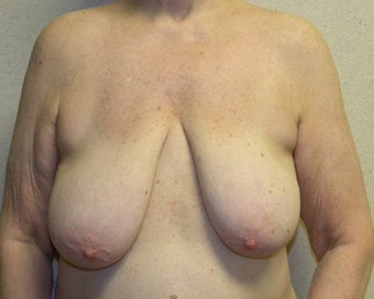 Breast Lift before 411125