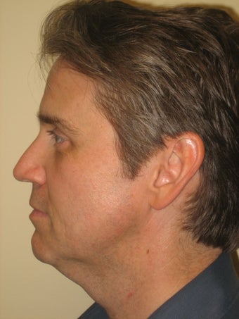 42 year old male before and after SmartLipo of the neck before 626272