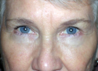 Upper and Lower Eyelid Blepharoplasty after 239944
