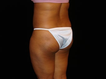 Buttocks Augmentation 517504