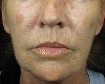C02 Results on Aging Female Face before 628475