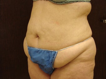 abdominoplasty, liposuction before 597251