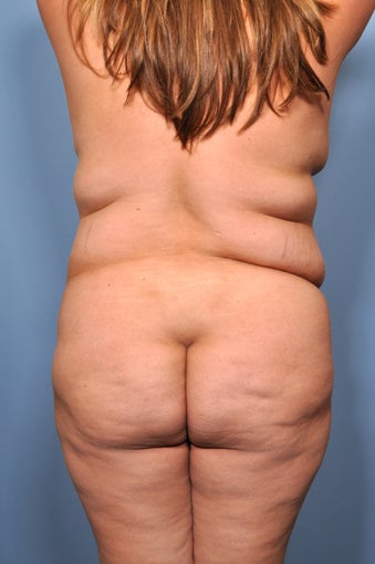 Liposuction before 521677