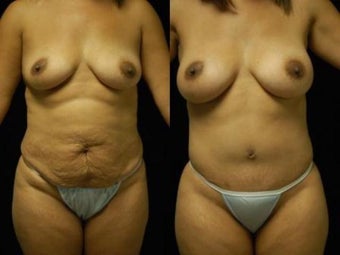 Tummy Tuck and Breast Augmentation before 392095