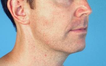 Neck Lift after 229651