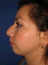 Chin Implants before 357642