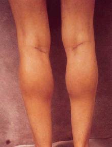 Women's Calf Augmentation after 519045