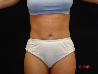 Liposuction Abdomen, Waist, Flanks, Outer Thighs with 6 Pack Abdominal Etching before 203550
