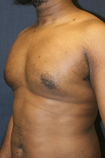 Gynecomastia after 509005