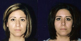 Rhinoplasty and Septoplasty before 241675