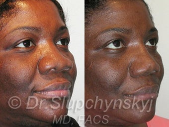 African American Rhinoplasty 525577