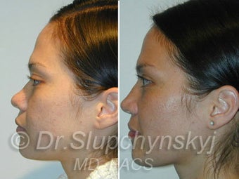 Asian Rhinoplasty 624582