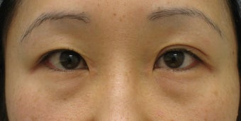 Upper and lower blepharoplasty by CO2 laser before 259539