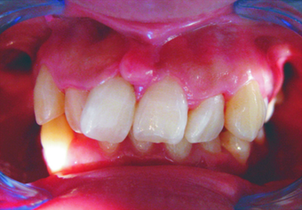 Complex orthodontics with Invisalign before 293389