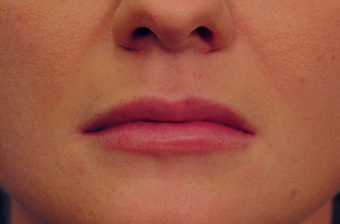 Injectable Filler after 149356