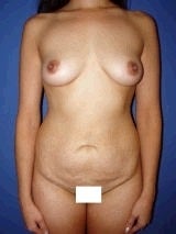 Breast Augmentation, Petite Frame Breast Augmentation, Tummy Tuck (Abdominoplasty) before 467906