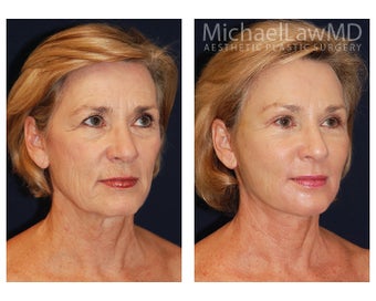 Facial Rejuvenation 395153
