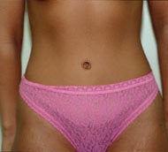 Tummy Tuck (Abdominoplasty) after 74761