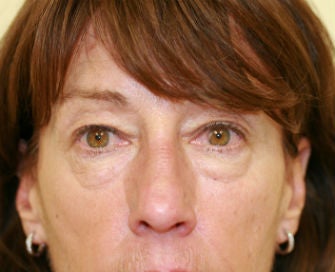Upper and Lower eyelid blepharoplasty before 380415