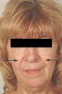 Restylane injections for laugh lines before 91296