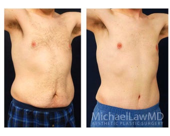 Abdominoplasty - Tummy Tuck after 396130