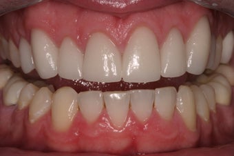 porcelain crowns after 330389