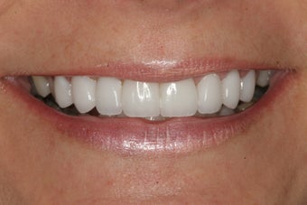 Smile Makeover with Minimal-Prep Porcelain Veneers after 94814