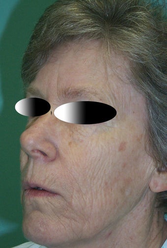 Full face laser resurfacing before 286172